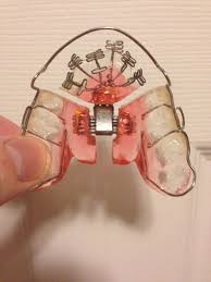 Vivos DNA orthodontic appliance