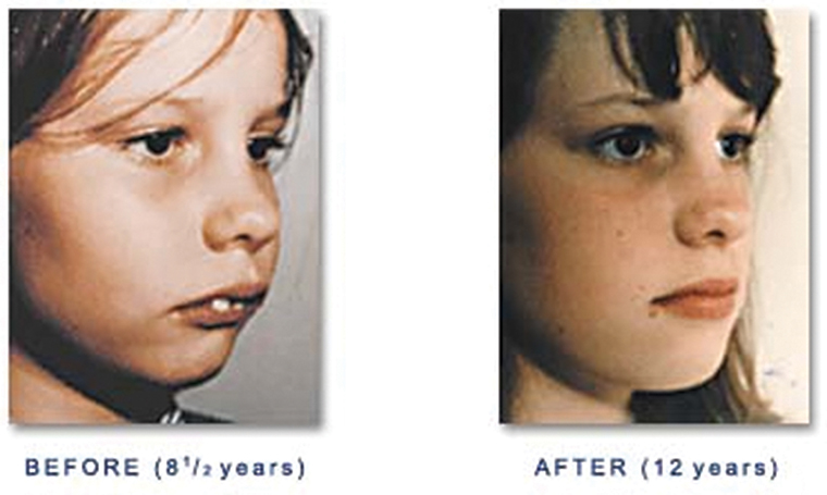 Non-Invasive Treatments to Correct Mouth Breathing in Children