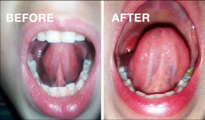 frenectomy tongue tie