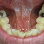 tongue tie link to crowded teeth