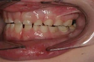 kids teeth grinding linked to sleep apnea