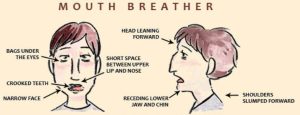 myobrace for mouth breathing