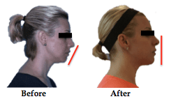  DNA expander before after picture