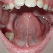 What Causes Tongue Tie?