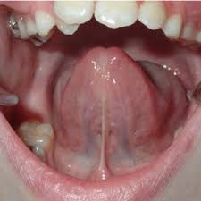 posterior tongue tie