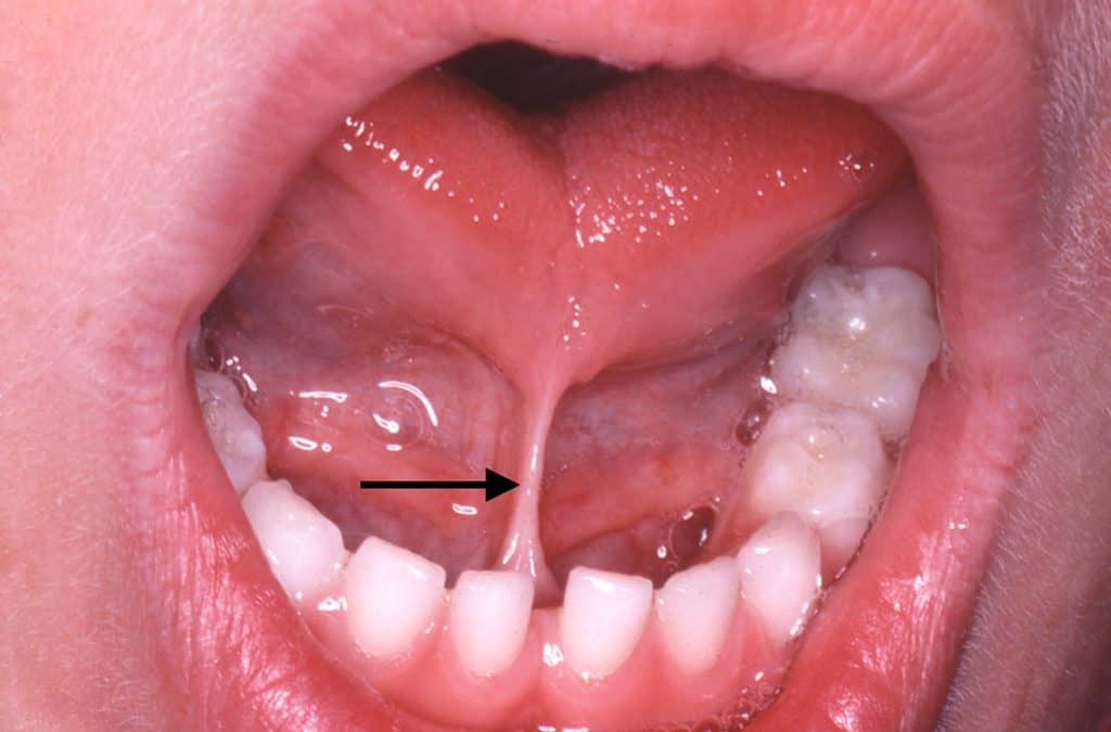 What is Tongue Tie?