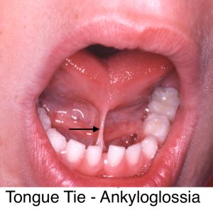 anterior tongue tie