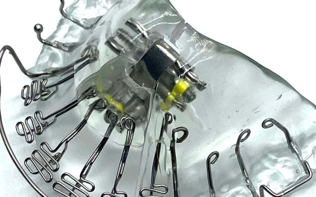 Getting DNA Appliance and Homeoblock Devices with Dental Implants