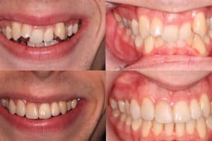 crozat palatal expander before and after