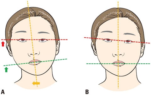 Link Between Mouth Breathing and Bad Posture