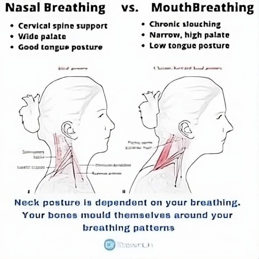 forward head posture and airway size