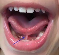 anterior tongue tie looks like