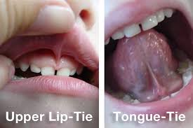 tongue tie looks like