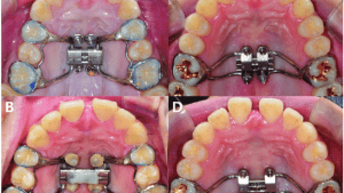MARPE Adult Palatal Expander Treatment and Cost