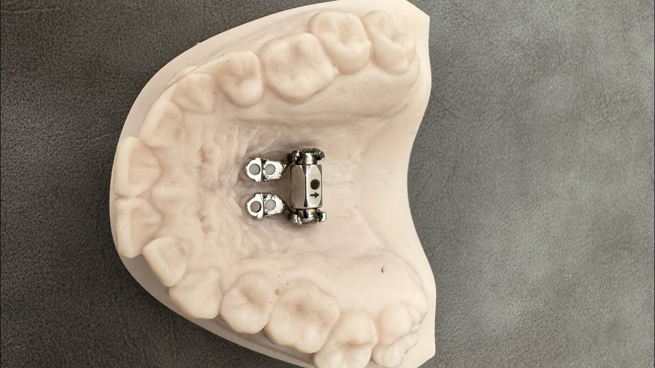 marpe expander