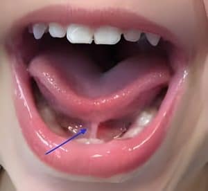 anterior tongue tie