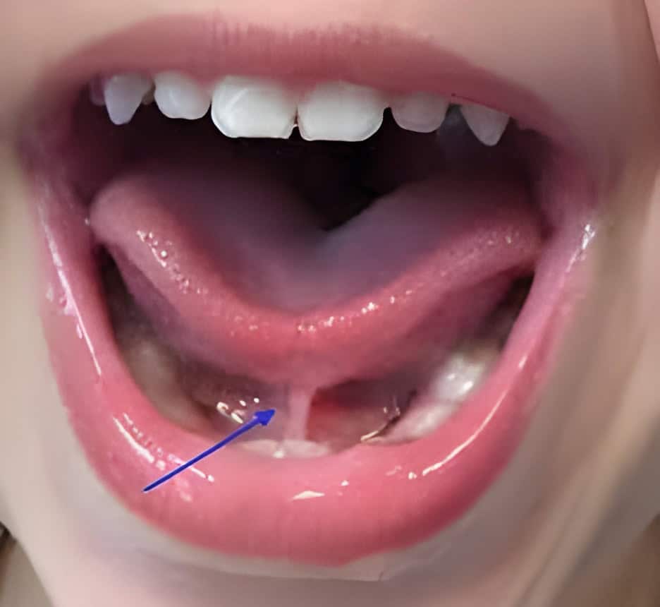 anterior tongue tie