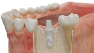 biological and holistic dental implants