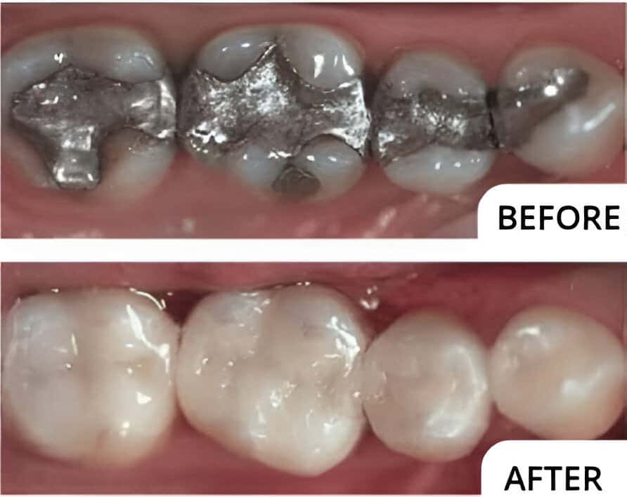 mercury filling removal