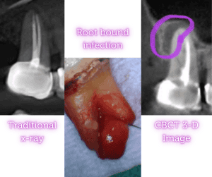 root canal removal