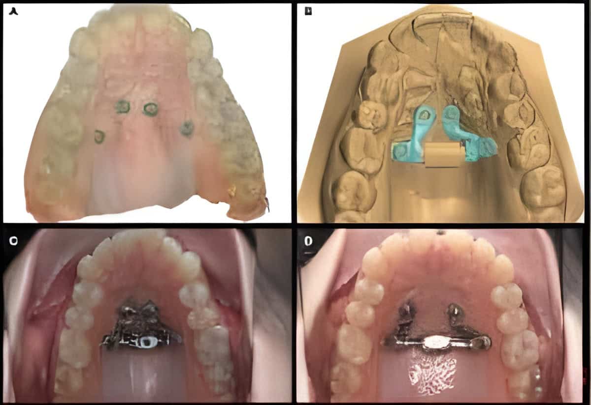 marpe expander slow palatal expansion
