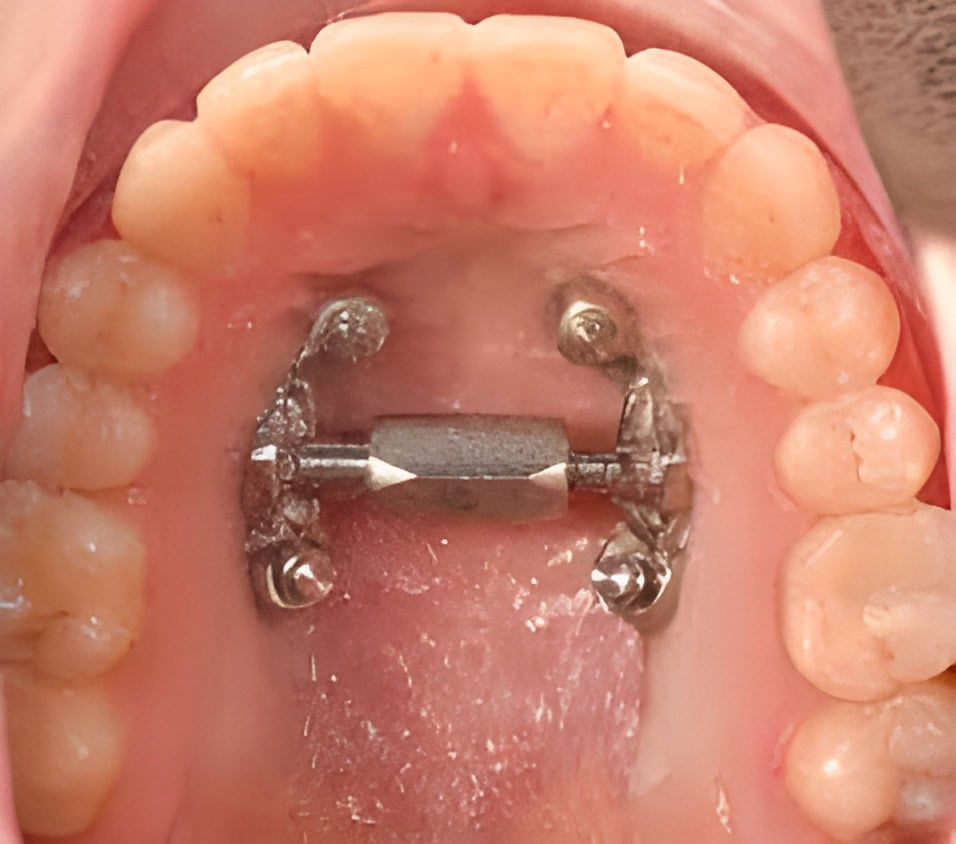 marpe palate expander