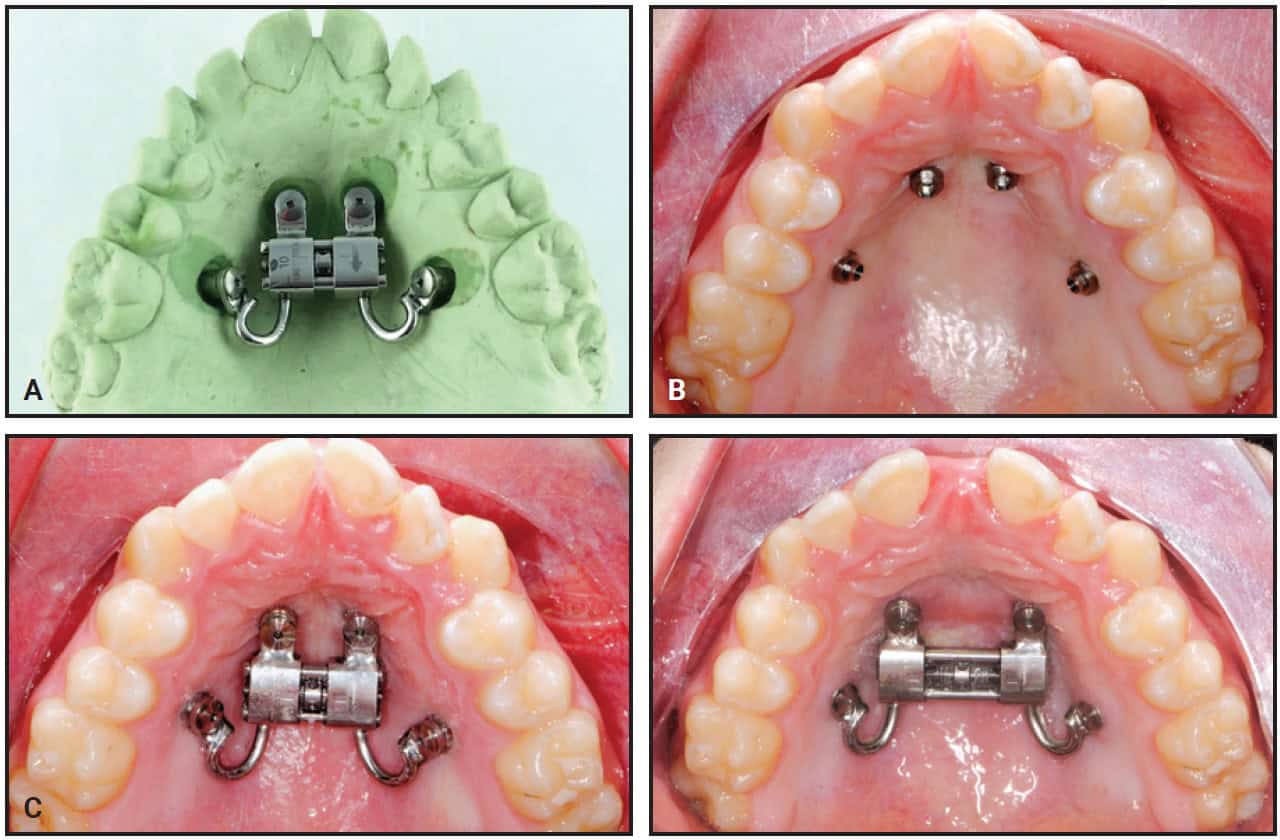 MASPE vs MARPE Palatal Expanders: What’s the Difference?