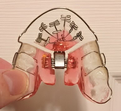 Holistic Orthodontics – Fix Mouth Breathing and Straighten Teeth Without Braces