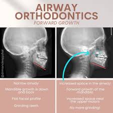 what is airway orthodontics