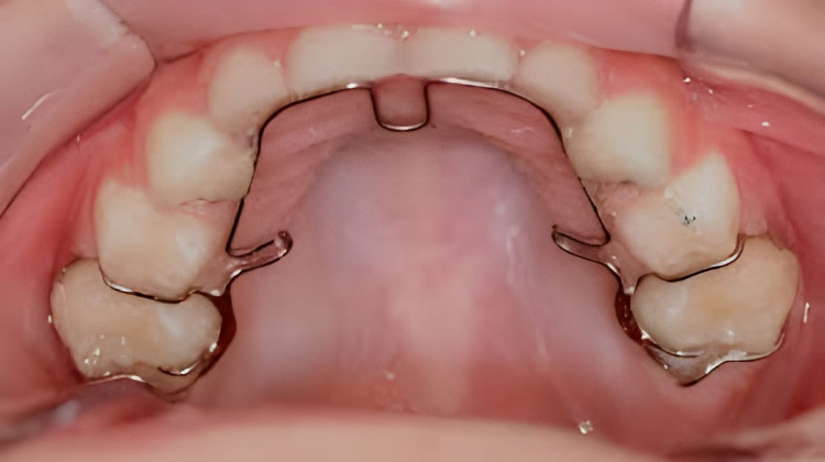 ALF Appliance is a Gentle Alternative to Braces