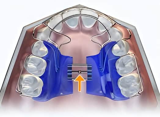 Biobloc Appliance: Orthotropics for Better Facial Development