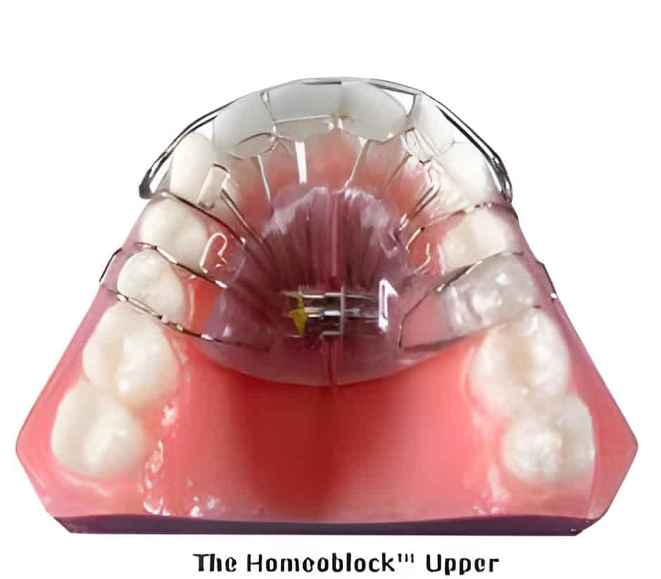 MSE and MARPE Expanders-Adult Skeletal Expansion Appliances