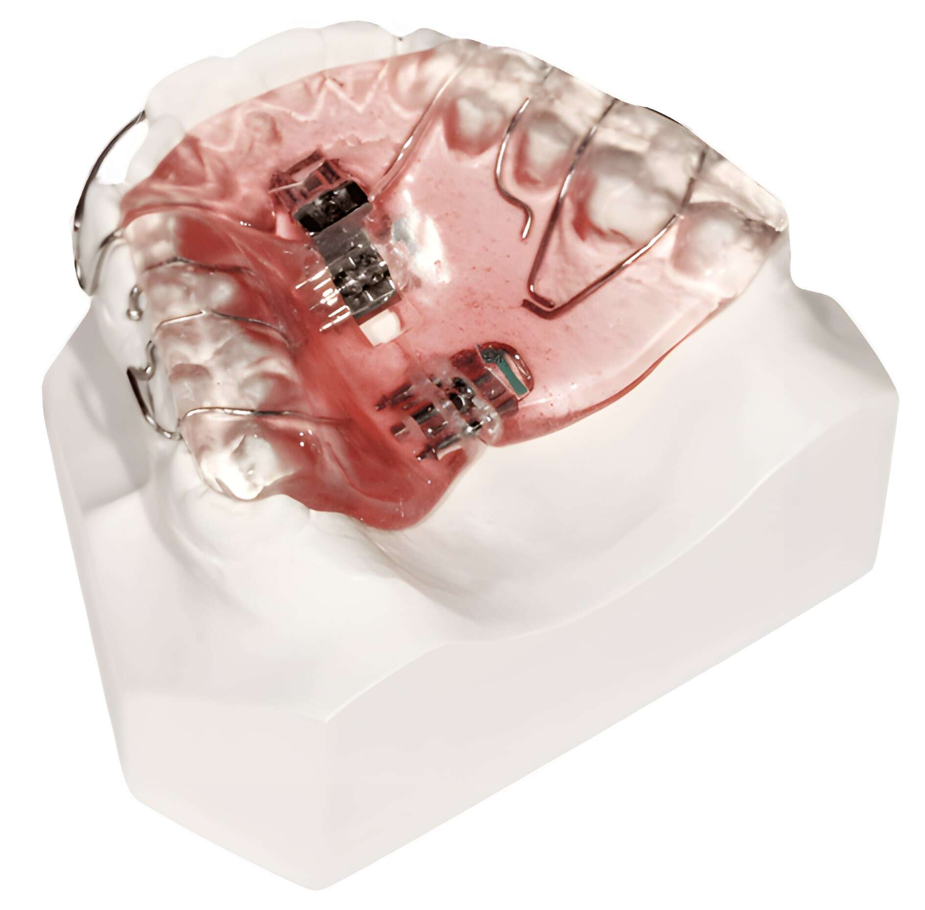 Schwarz Palatal Expander for Crowded Teeth, Mouth Breathing and Pediatric Sleep Apnea