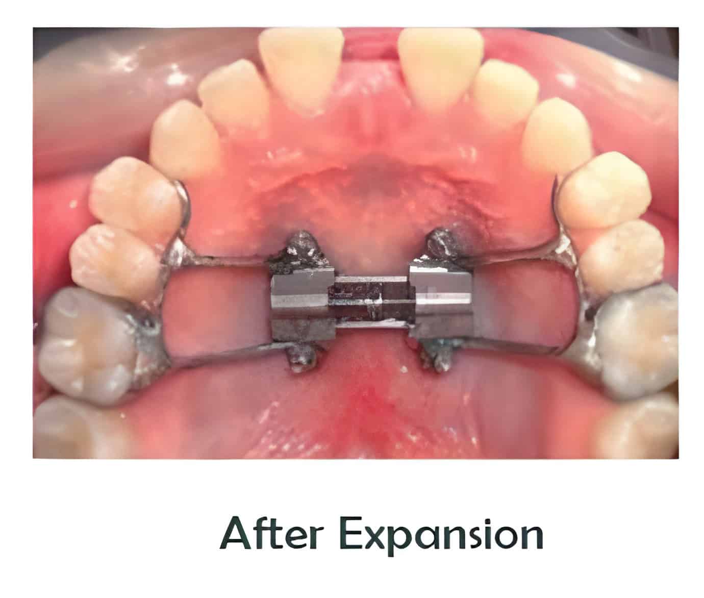 Exploring MARPE Expander-How it Works, Costs and Alternatives