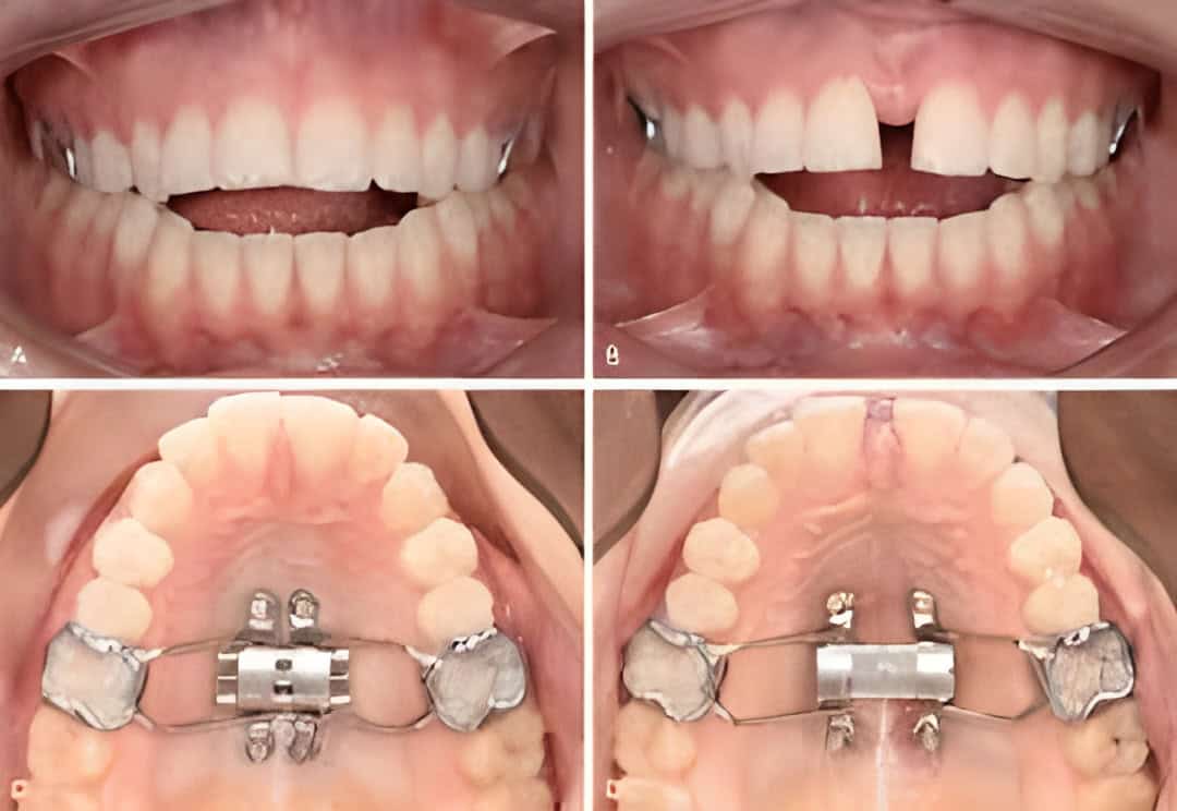 Exploring MARPE Expander-How it Works, Costs and Alternatives