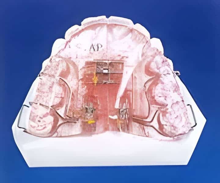 orthodontic growth expander palatal expanders