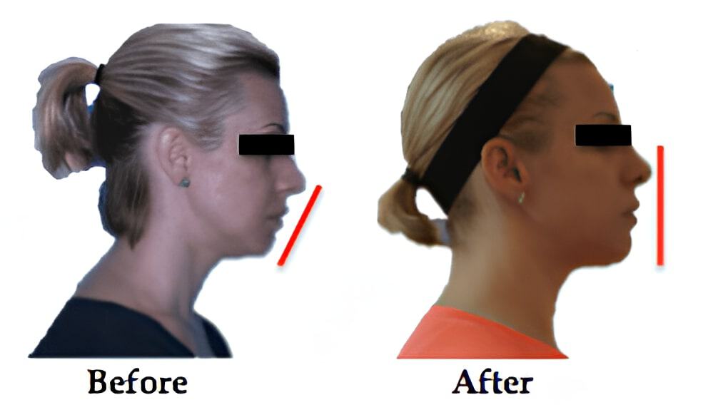 DNA Appliance relieves TMJ Pain and Sleep Apnea