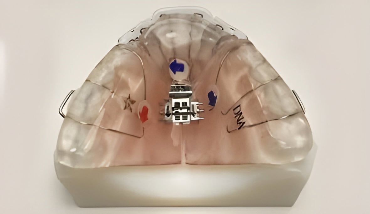 Adult Palatal Expanders – MARPE, DNA Appliance and Homeoblock