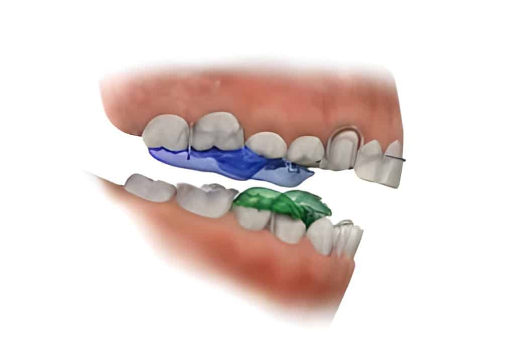 Kids Palatal Expander Guide-Correct Mouth Breathing and Pediatric Sleep Apnea