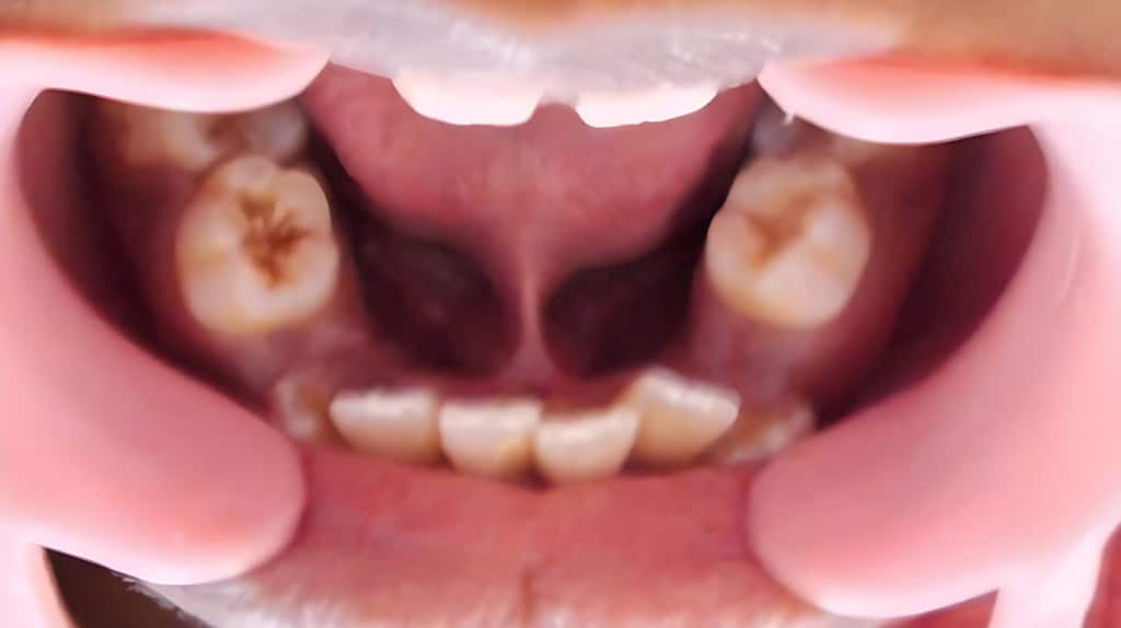 tongue tie tooth crowding