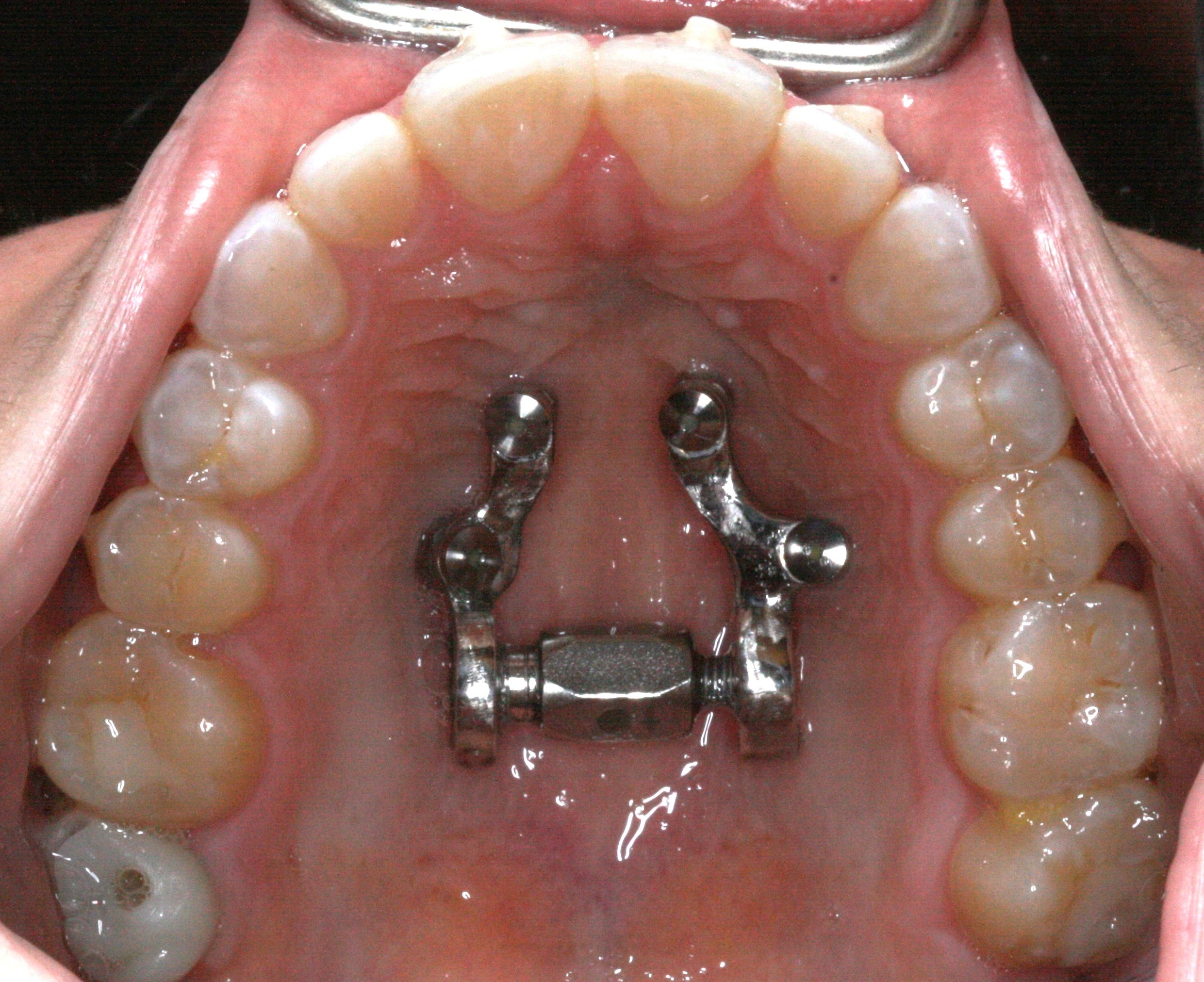 Adult Palatal Expanders-Breath Sleep Look and Feel Better